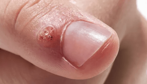 Natural Wart Remover